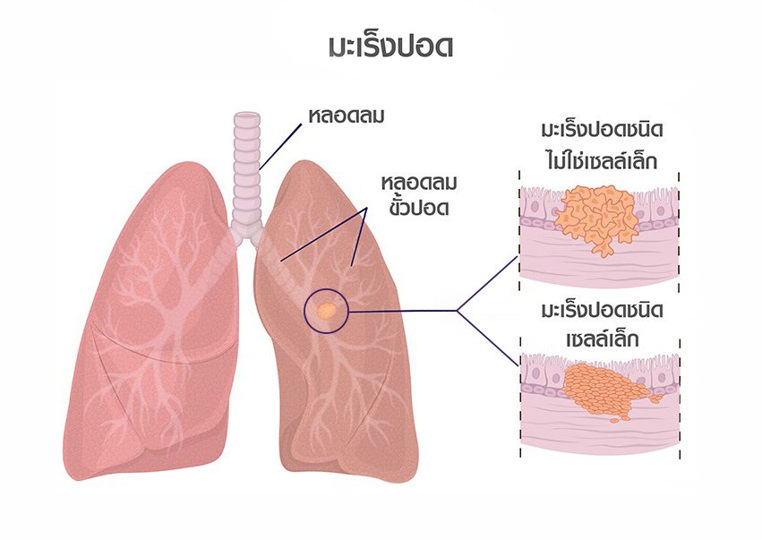 มะเร็งปอดอาการ